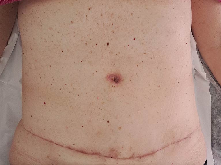 Drenaje linfático Abdominoplastia