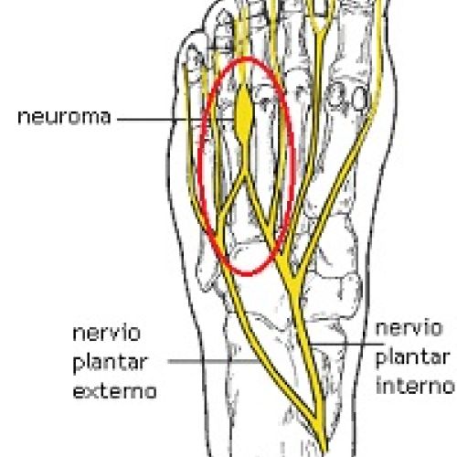 Neuroma de Morton