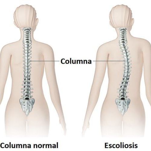 Escoliosis