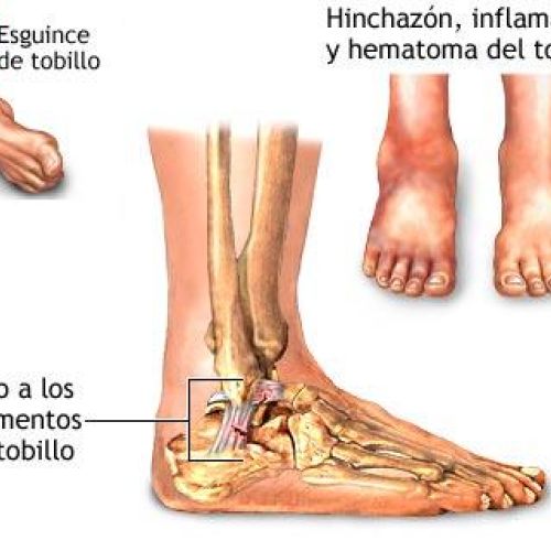 Esguince de tobillo