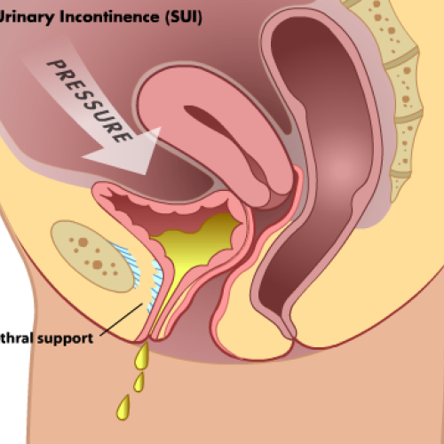 Incontinencia Urinaria