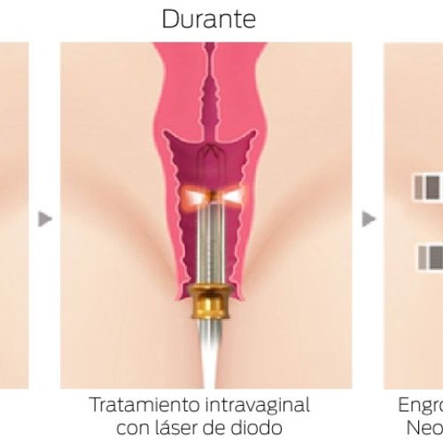 Láser vaginal