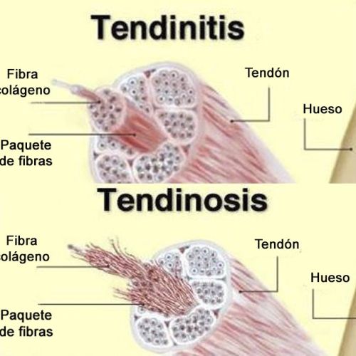 tendinitis/tendinosis